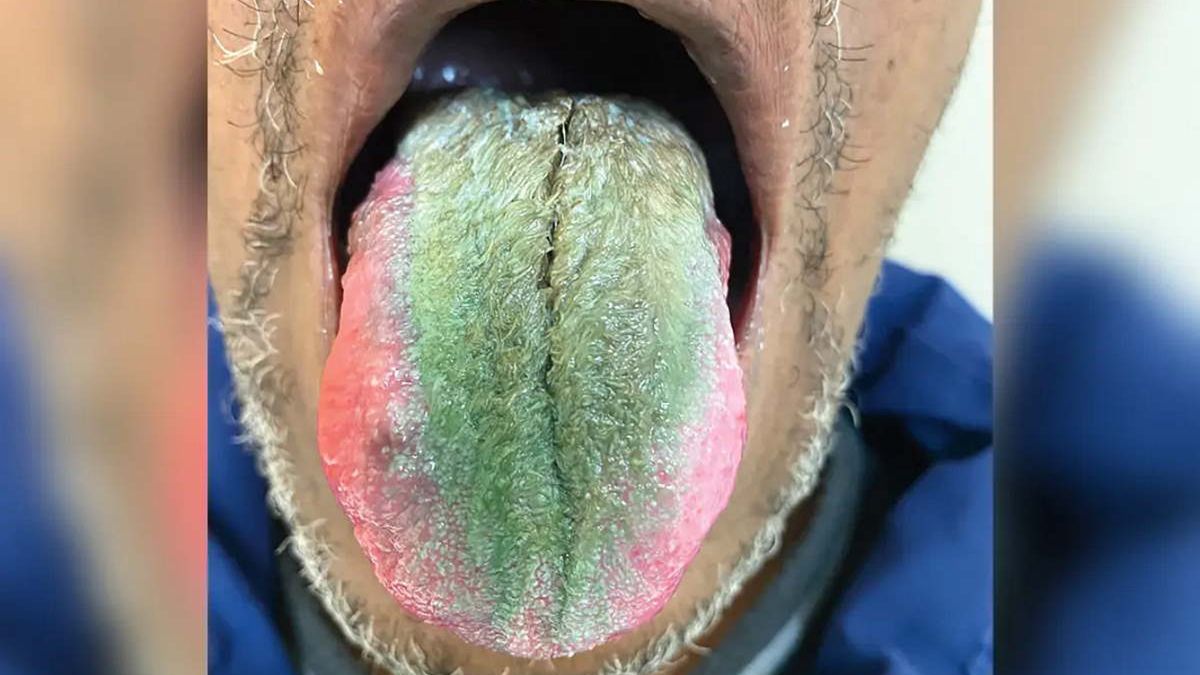 Szmaragdowy i włochaty. Lekarze pokazują zdjęcie języka pewnego pacjenta