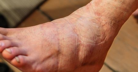 Ten kolor zauważysz na nogach. Znak, że cholesterol zapycha tętnice