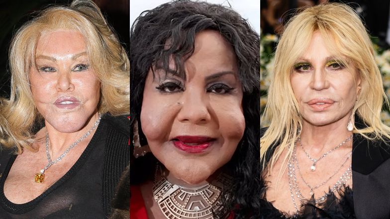 Nieudane operacje plastyczne gwiazd