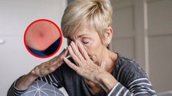 Gwałtowny wzrost przypadków boreliozy i KZM. Lekarze wskazują przyczyny