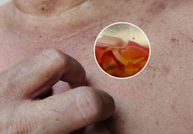 Usuwają przebarwienia i plamy starcze. 2 składniki, które na pewno masz w kuchni