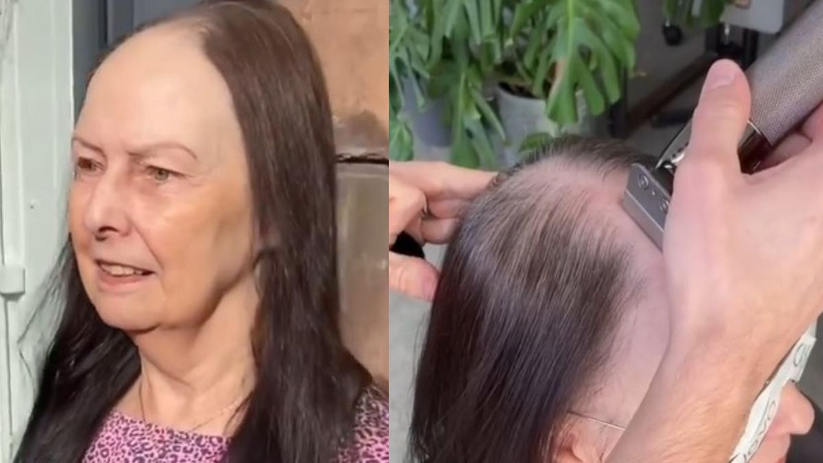 Ma dużą łysinę. Jedna wizyta u fryzjera odmieniła jej wygląd