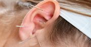 Akupunktura ucha – wskazania i przeciwwskazania. Jak przebiega procedura?