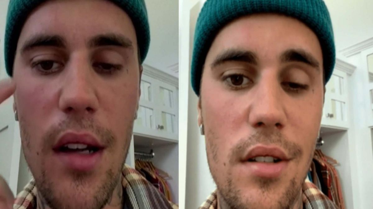 Justn Bieber cierpi na zespół Ramsaya Hunta