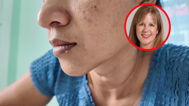 Ciemna plama na twarzy? Ten szczegół powinien zaniepokoić