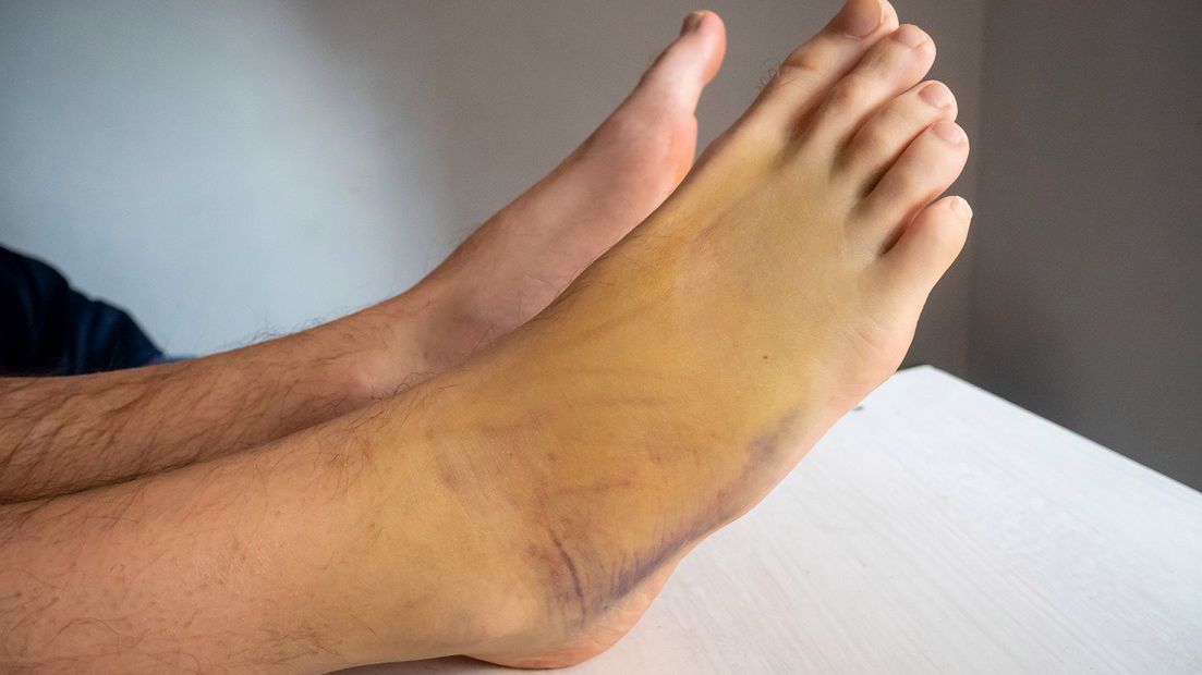 Dlaczego po szczepionce na COVID-19 dochodzi do zakrzepów? Ekspert wymienia dwie możliwości