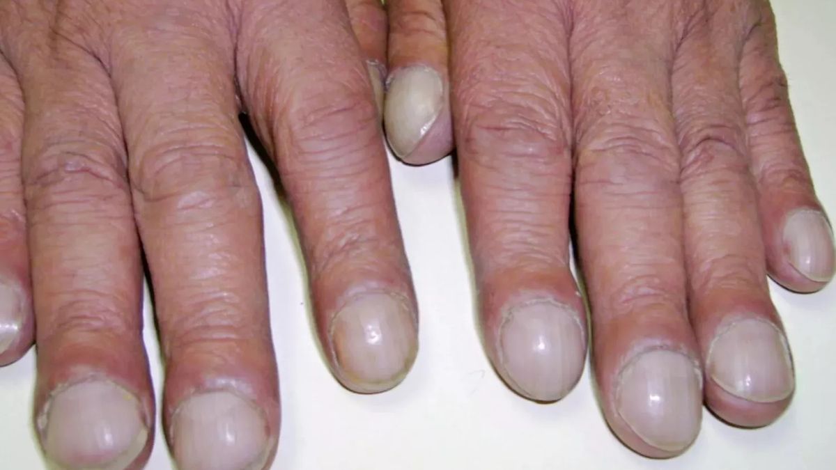 Pojawiają się przy raku płuc i innych groźnych chorobach. Nie batelizuj wyglądu dłoni