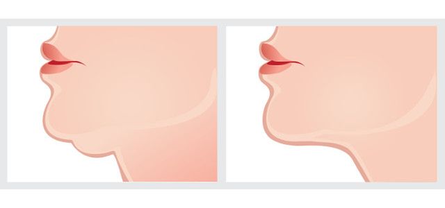 Aby problem podwójnego podbródka przestał być naszym utrapieniem, wystarczy odrobina motywacji i regularnych, prostych ćwiczeń