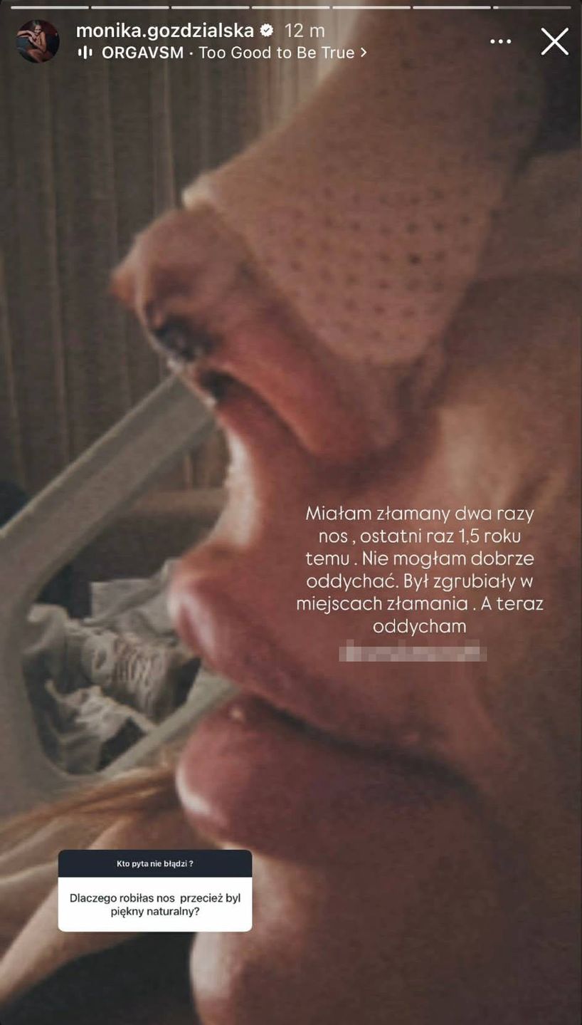 Monika Goździalska o operacji nosa 