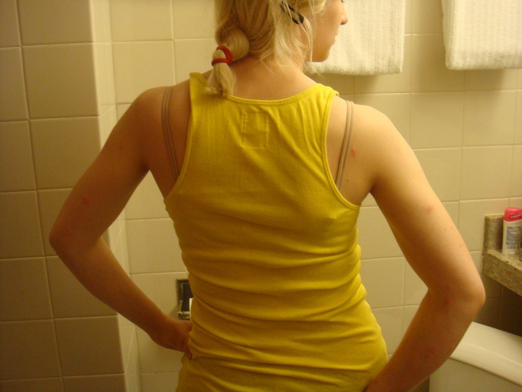 Rwa kulszowa - przyczyny, objawy, leczenie. Czym jest objaw Lasegue'a?