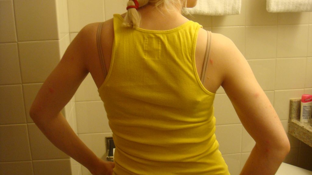 Rwa kulszowa jest jednym z najczęściej spotykanych zespołów bólowych dolnej części kręgosłupa