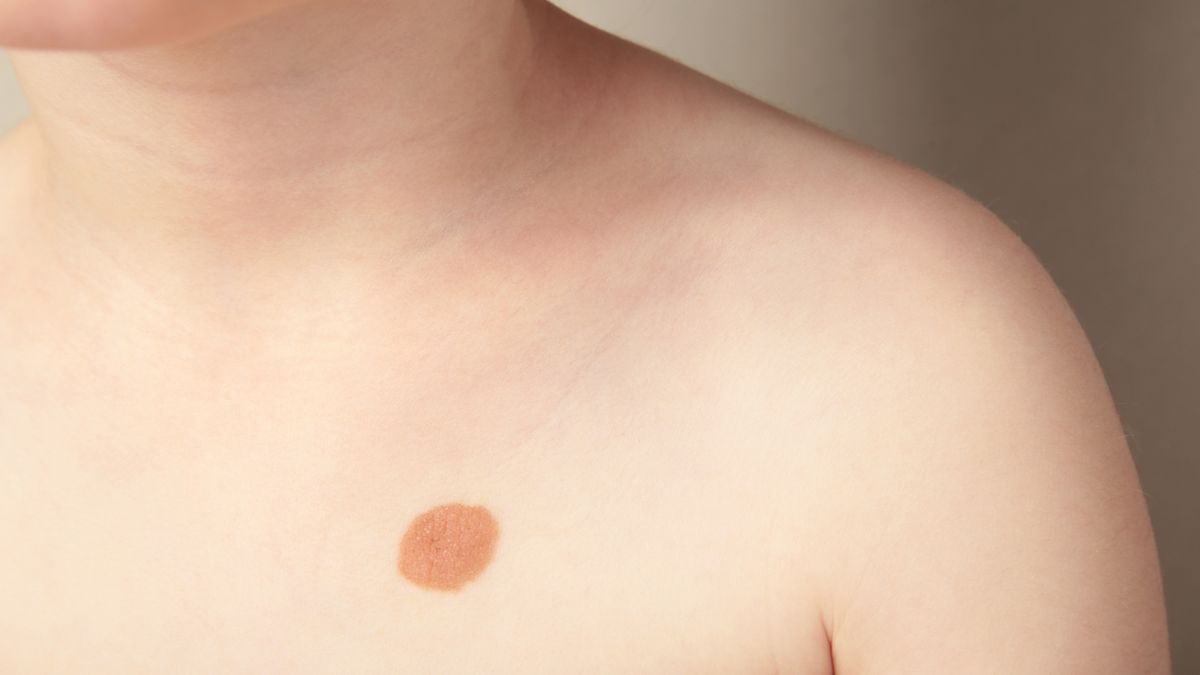 Znamię u dziecka warto skonsultować z lekarzem dermatologiem