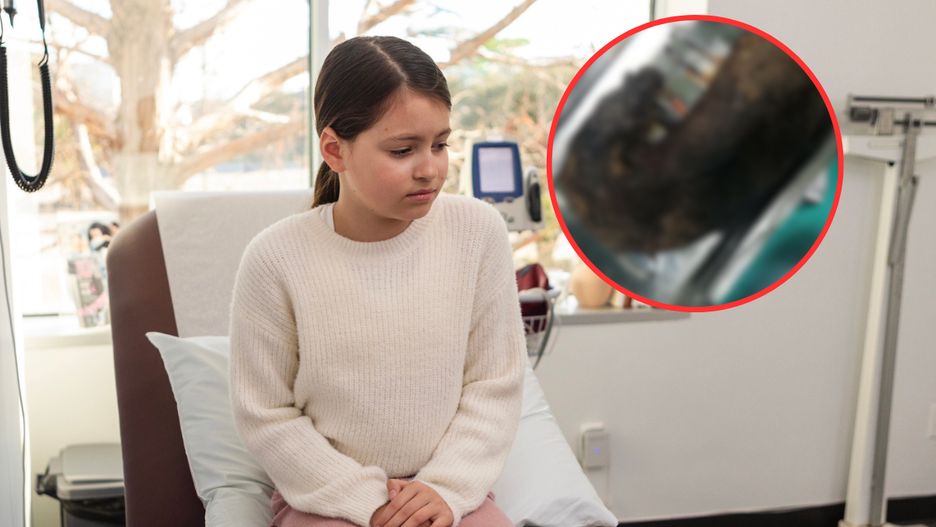 Lekarze byli w szoku. W żołądku 9-latki  znaleźli prawie kilogram włosów