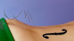 Akupunktura na odchudzanie