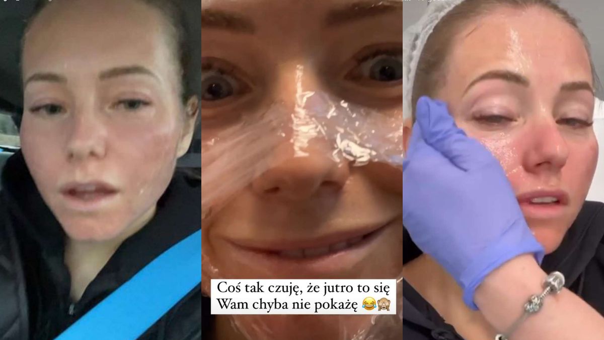 Opuchnięta Agata Rubik relacjonuje wizytę w klinice 