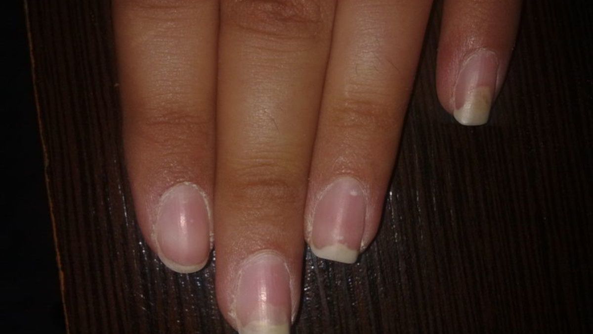 Niedobór żelaza może dawać nietypowe symptomy