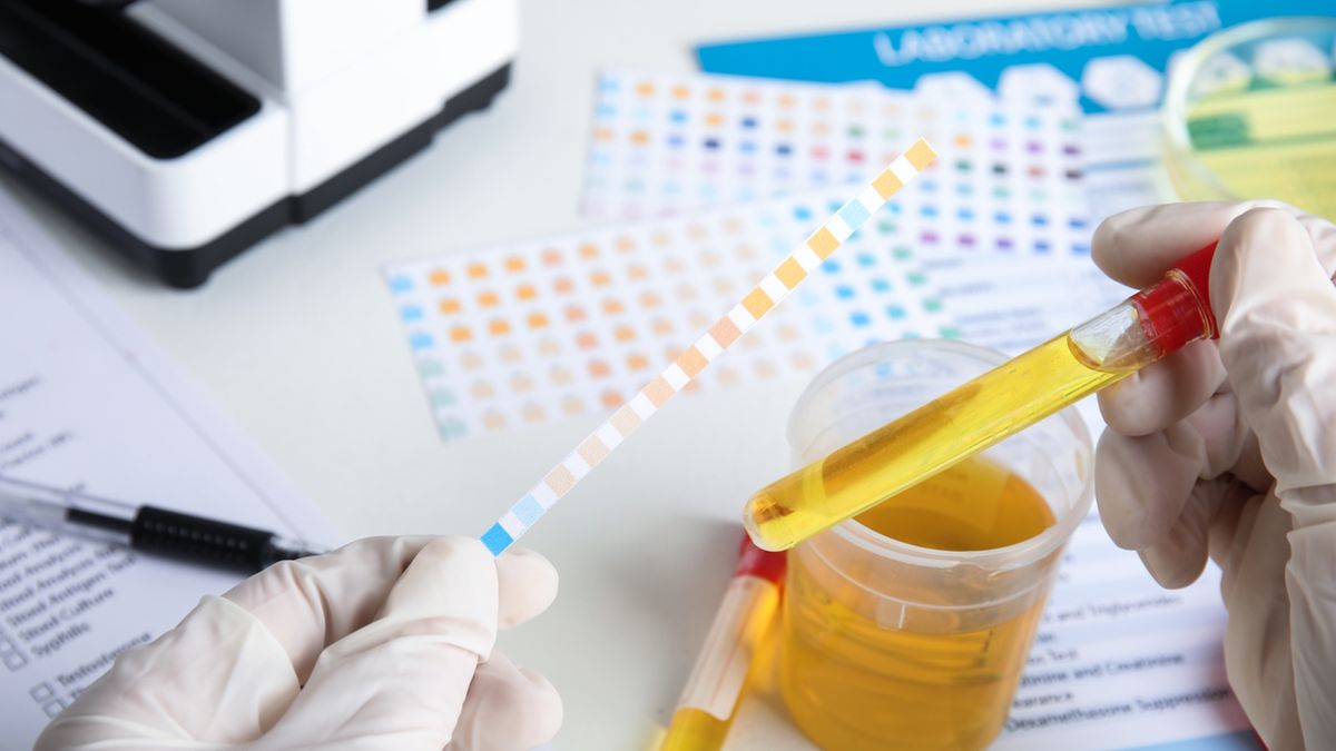 Glukozuria oznacza obecność glukozy w moczu