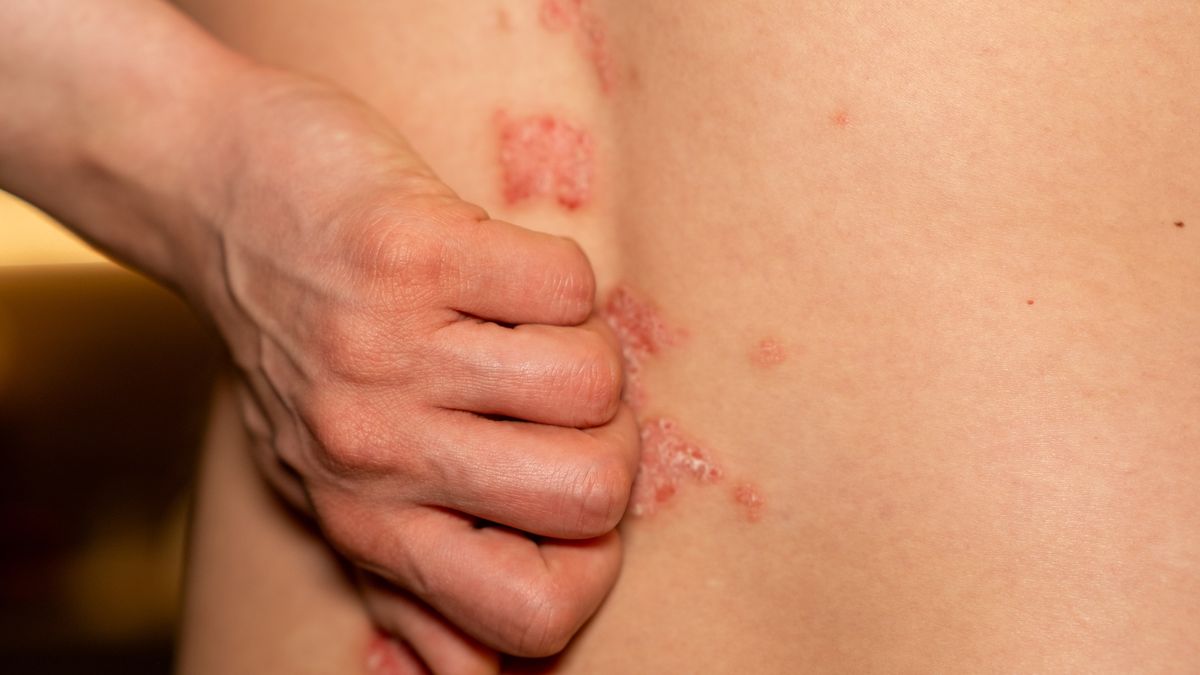 Symptoms of psoriasis visible on skin with red,Itchy patches affecting the back area during indoor
Red, itchy, and scaly patches of psoriasis are evident on the skin of a persons back, highlighting the impact of this genetic immune condition.
Anatolii Savitskii  / 500px
disease, dermatological, health, wellness, discomfort, itchy, cultural, body, treatment, management, challenges, medical, professionals, chronic, diagnosis, lesions, daily, autoimmune, scaly, healthcare, options, patches, symptoms, holistic, immune, issues, disorder, groups, genetic, awareness