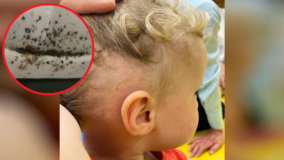 Krótki wyjazd zamienił się w koszmar. 2-latka w hotelu pogryzły pluskwy