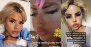 Gwiazdka brytyjskiego "Love Island" chwali się efektami operacji w tureckiej klinice: "Czuję się jak LALKA BRATZ"