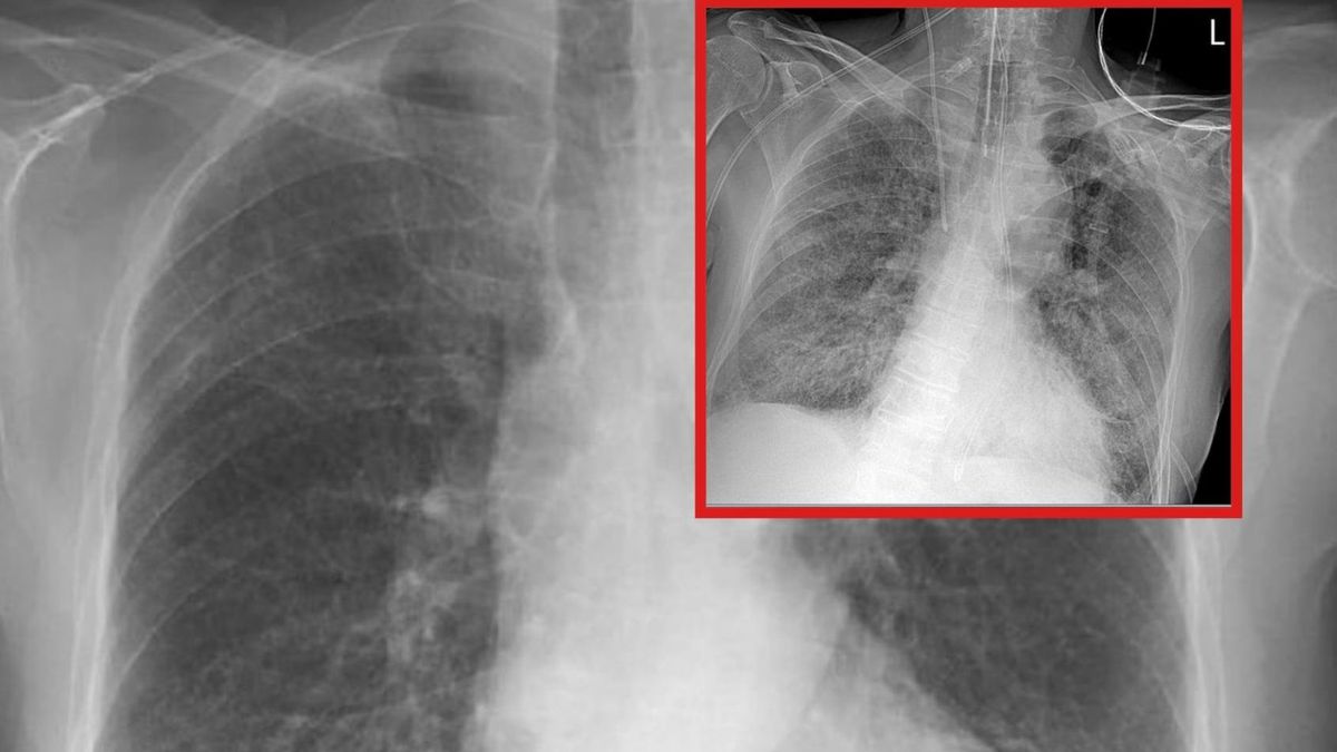 Obraz płuc, na którym widać zapalenie płuc