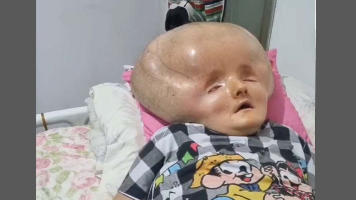 Rzadka choroba odebrała jej normalne życie