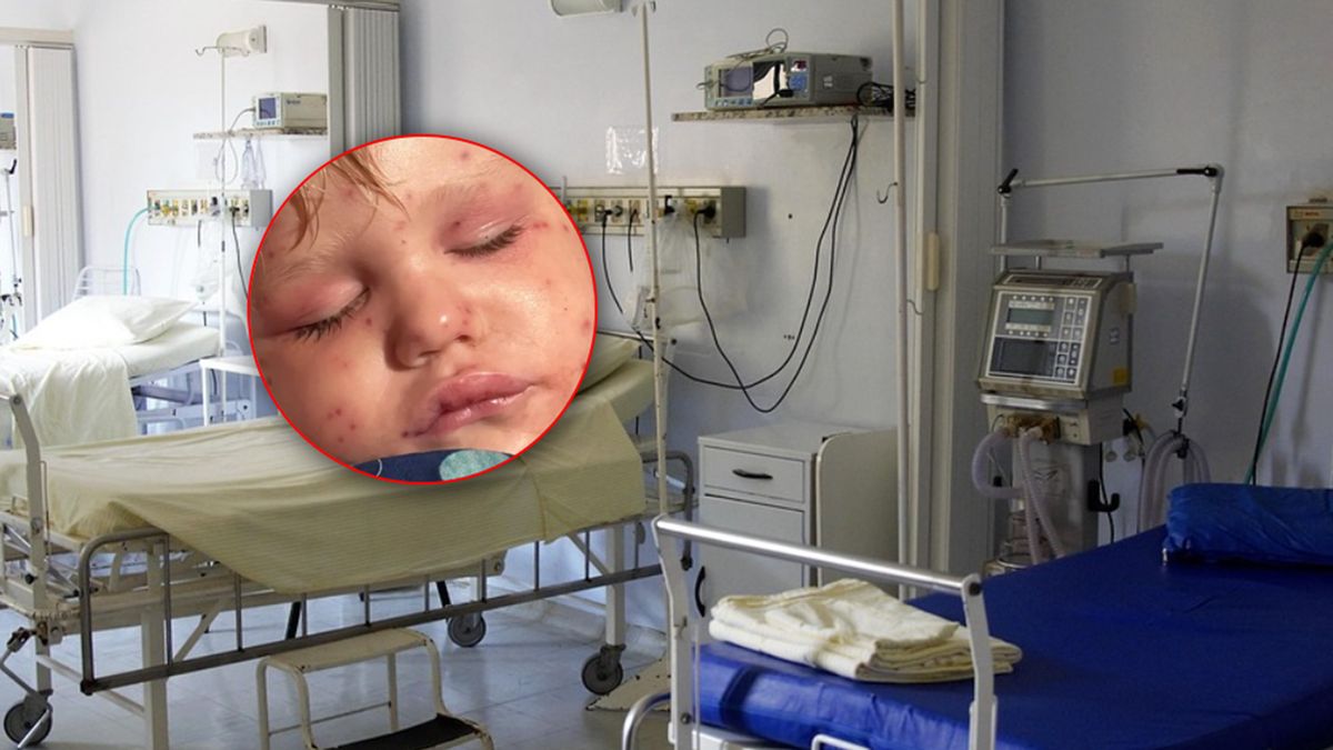 Beckham Reed użądlony przez osy.