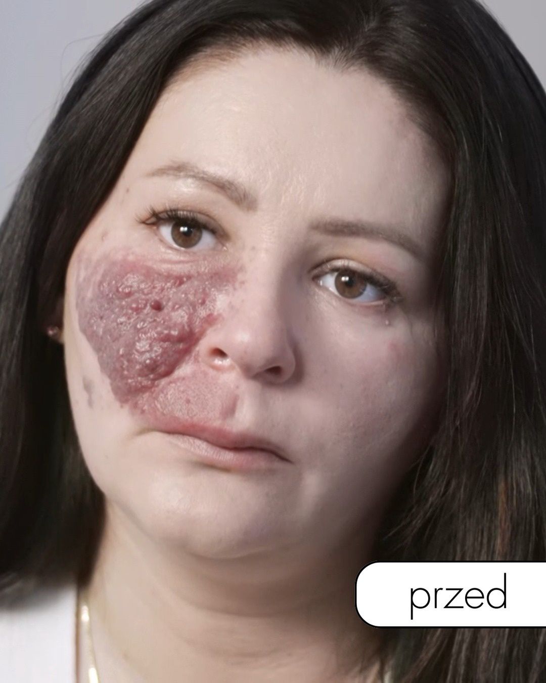 Marta zgłosiła się do programu z rozległą zmianą na twarzy