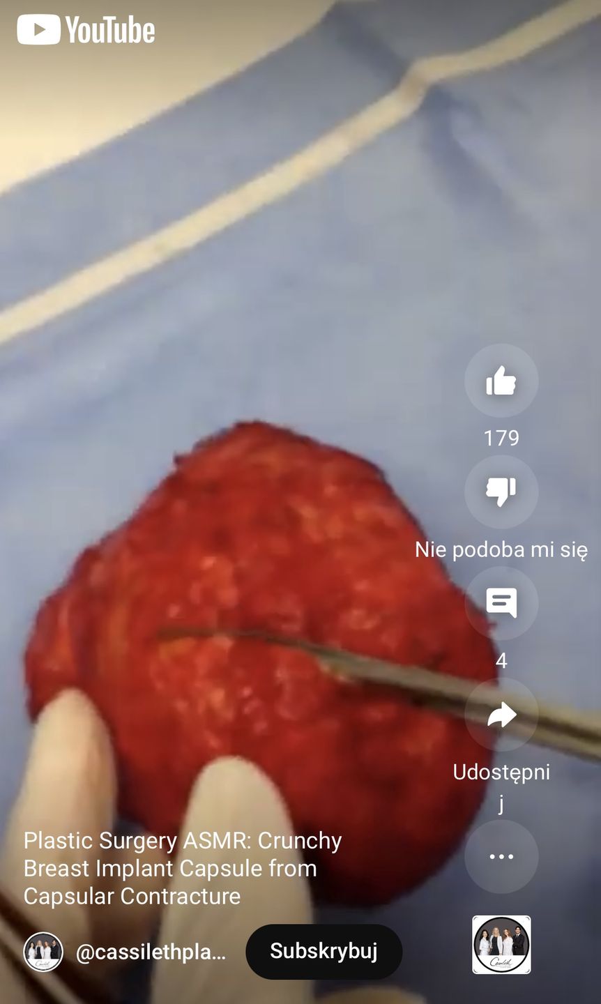 Pokazali, jak wygląda 10-letni implant piersi
