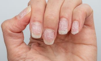 Kosztuje grosze w aptece. Wcieraj regularnie, a paznokcie "odżyją"