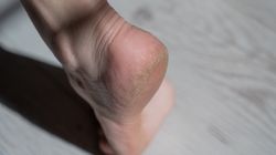 Te choroby rozpoznasz po stanie stóp. Obserwuj zmiany