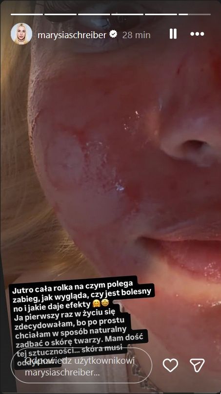 Marianna Schreiber pokazała się po zabiegu kosmetycznym