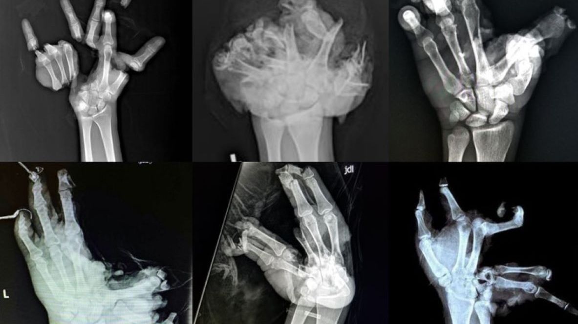 Tak może się skończyć nieodpowiedzialna zabawa z fajerwerkami 