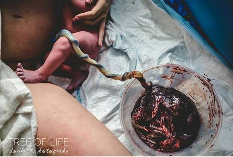 Zdjęcie łożyska po porodzie