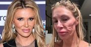 Brandi Glanville z "Żon Beverly Hills" ma  poważne problemy z twarzą. "Choroba powiązana z IMPLANTAMI PIERSI" (ZDJĘCIA)