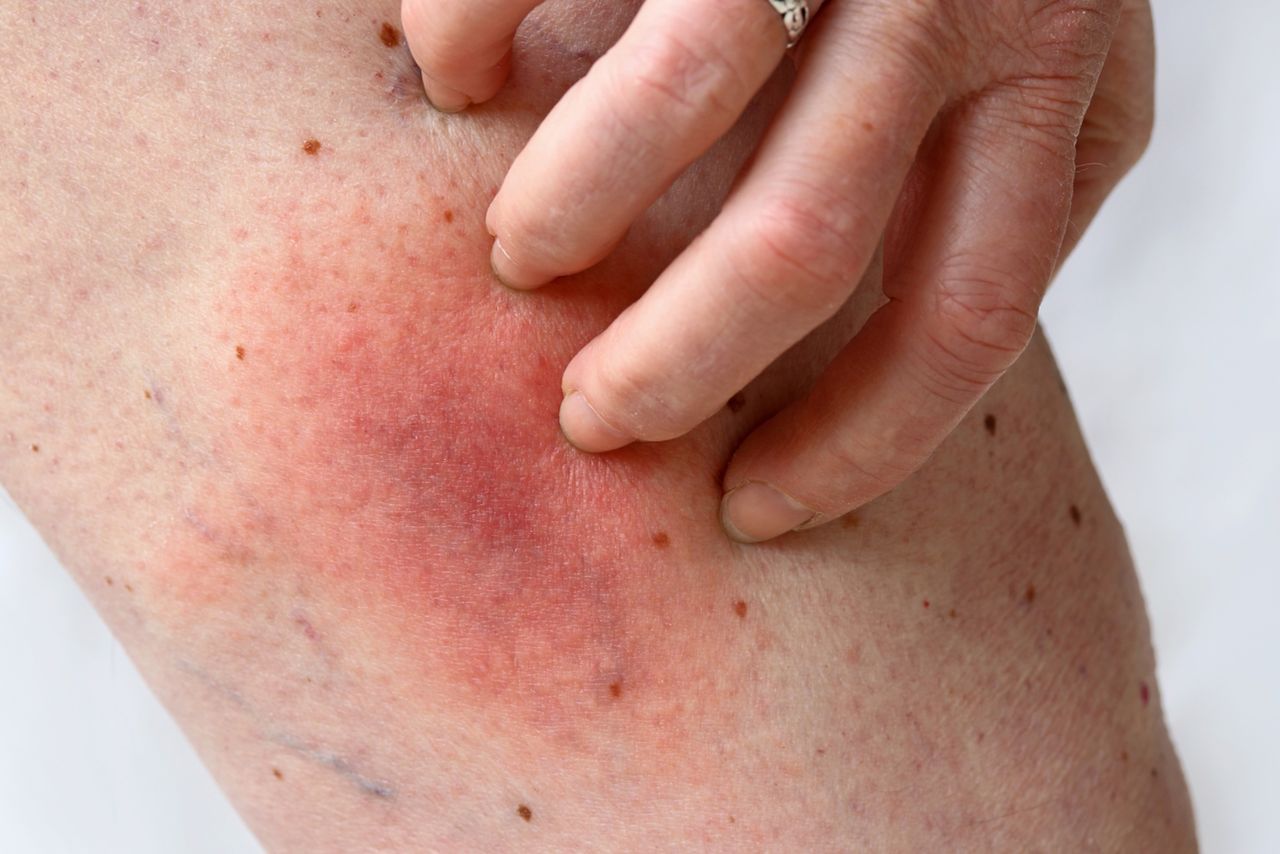 Rumień wielopostaciowy – przyczyny, objawy, odmiany, leczenie