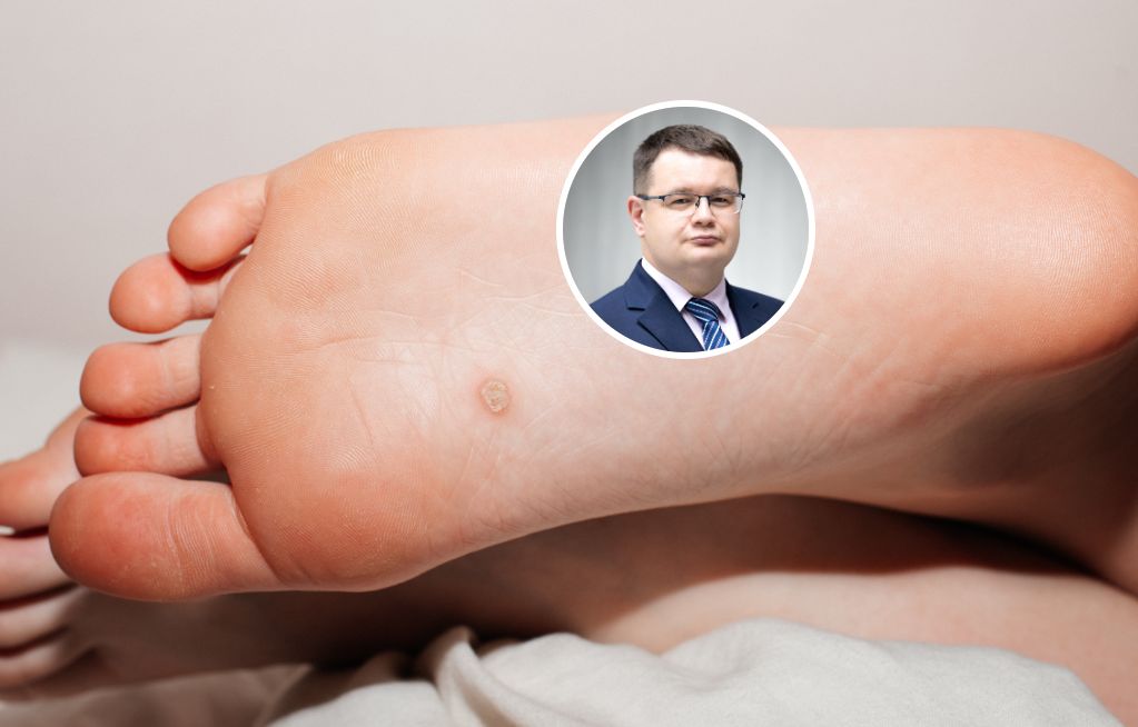 Domowe sposoby na leczenie kurzajek. Dermatolog przestrzega