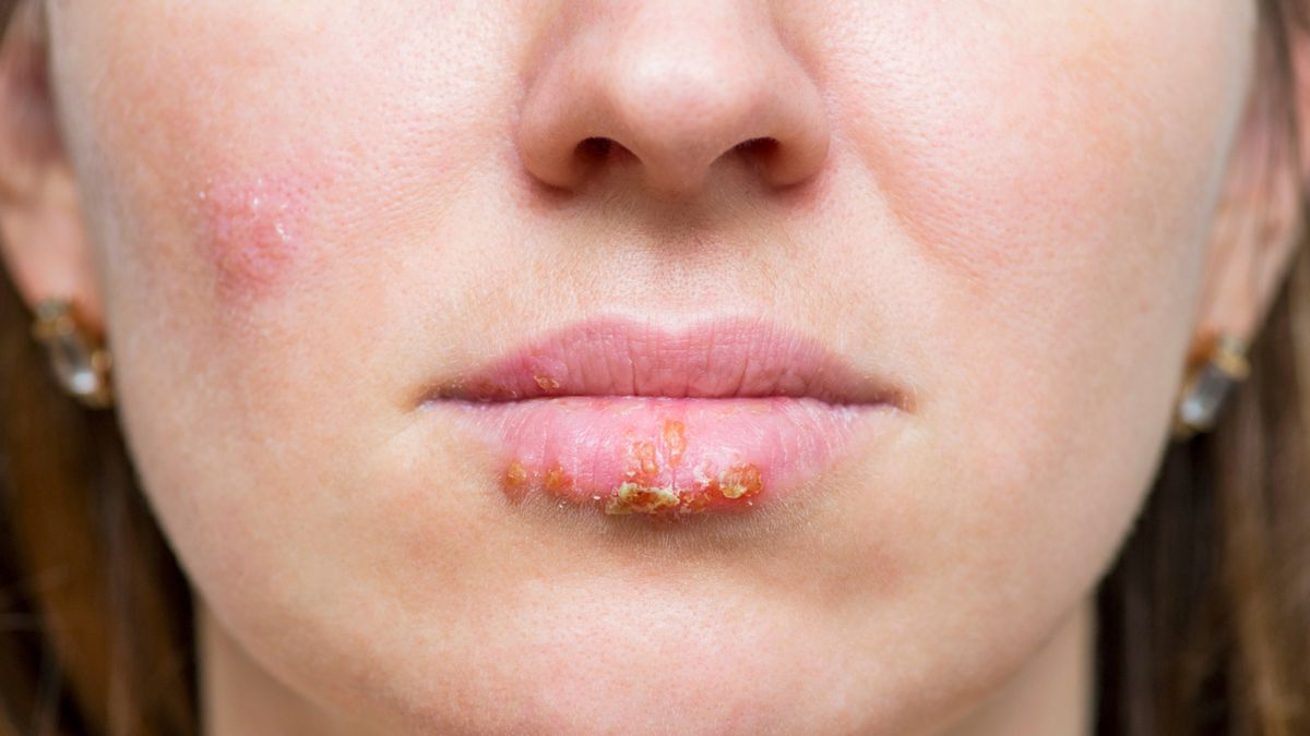 Liszajec zakaźny charakteryzuje się występowaniem strupów w kolorze miodowożółtym