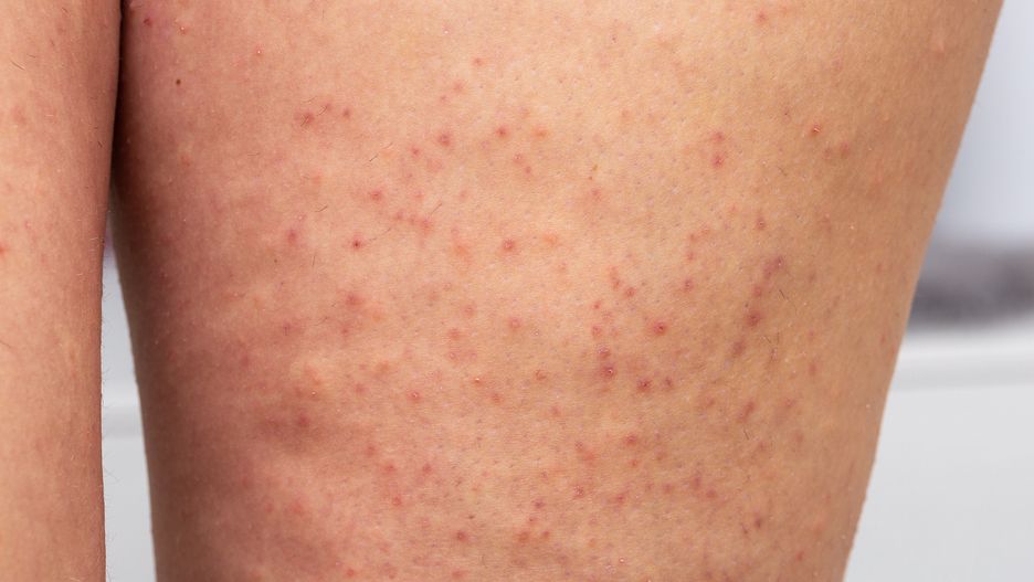 close-up of woman's legs with keratosis pilarar
close-up of woman's legs with keratosis pilarar, an acute folliculitis causing pinpoint redness, dermatological care concept
sruilk
bumps, caucasian, clinic, closeup, detail, epilation, examination, female, follicles, healthy, human, ingrown hair, isolated, keratin, keratinocytes, keratosis, legs, macro, medical, peeling, pilaris, pillar, problem, redness, seborrheic, surface, treatment, woman, young