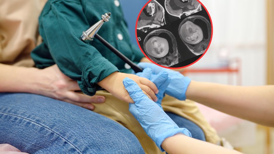 W głowie dziewczynki odkryli fetus in fetu