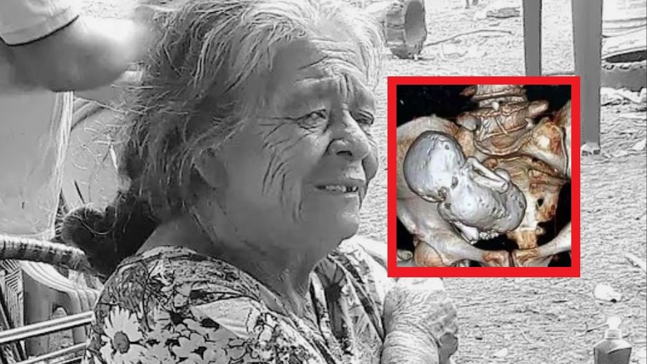 Szokujące odkrycie. 81-latka miała w brzuchu 56-letnie dziecko