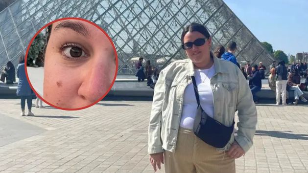 Drobna zmiana na policzku okazała się czerniakiem