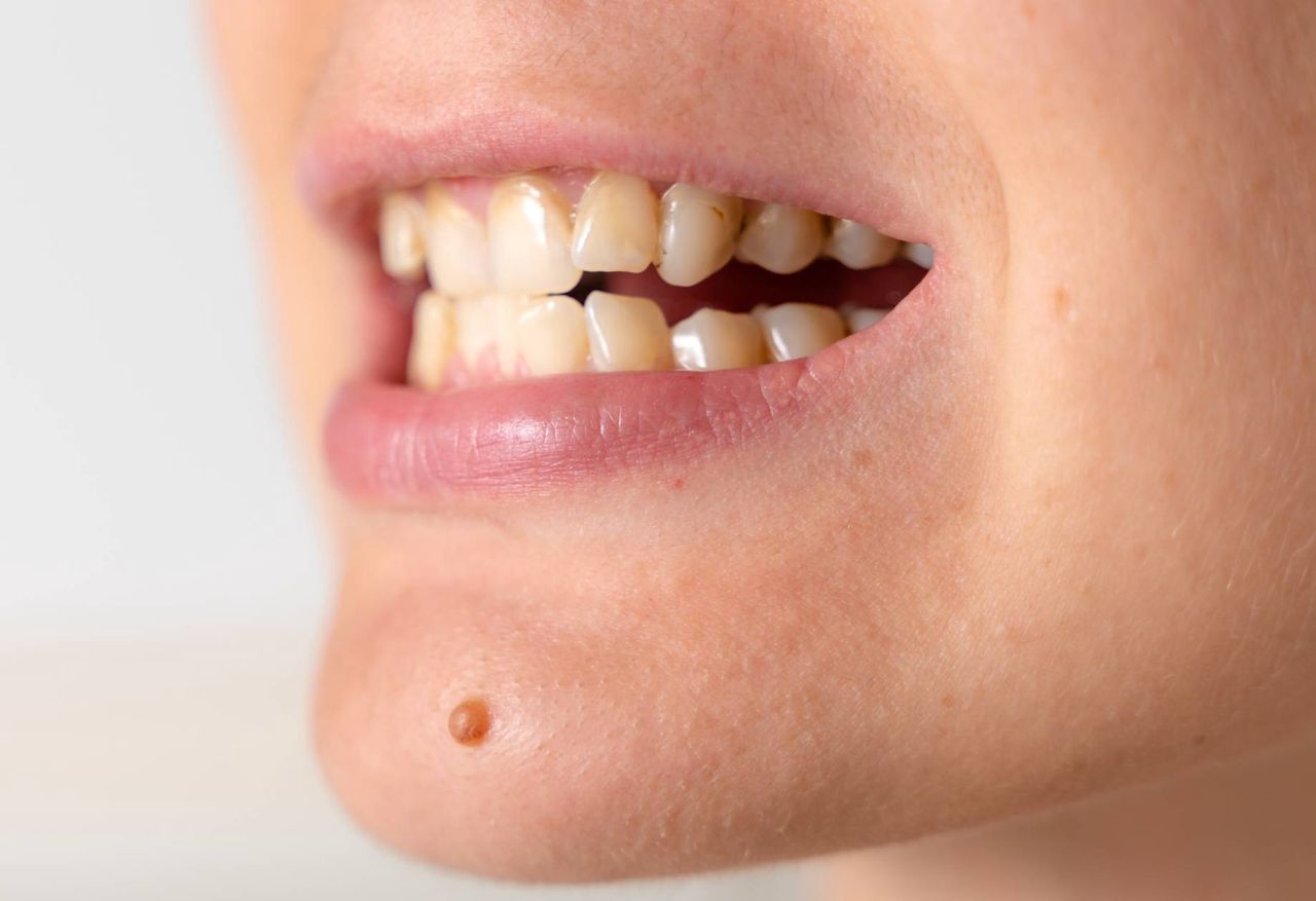 Are your genes affecting your smile's whiteness?
