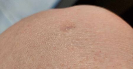 Legnica: Twoje znamię budzi niepokój? Za darmo obejrzy je chirurg onkolog