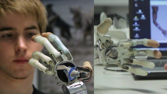 Bioniczna ręka pomogła mu wrócić do normalności 1