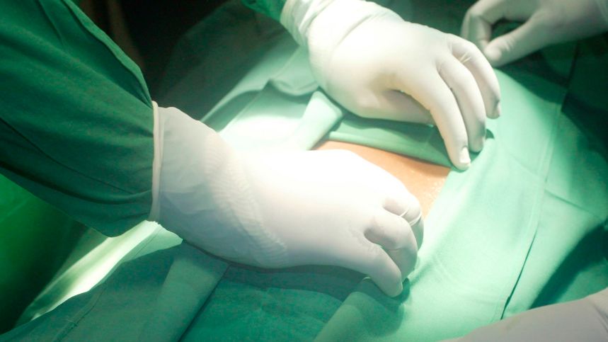 Powikłania, które mogą wystąpić po usunięciu wyrostka robaczkowego to m.in. zapalenie otrzewnej, zakażenie rany pooperacyjnej.