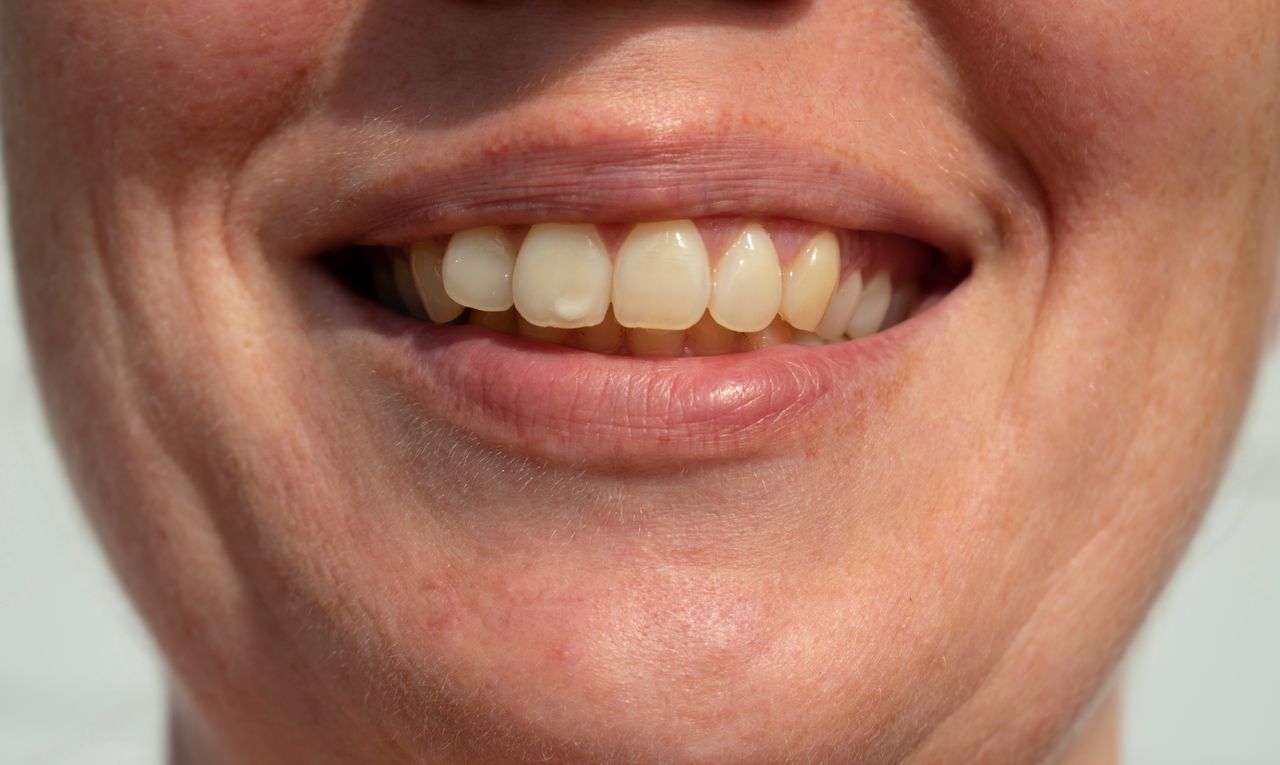 Prosecco's sparkling threat: Dentists warn of yellowing smiles