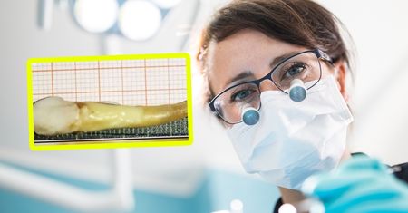 Dentyści nie mogli uwierzyć własnym oczom. Miał prawie 4 centymetry