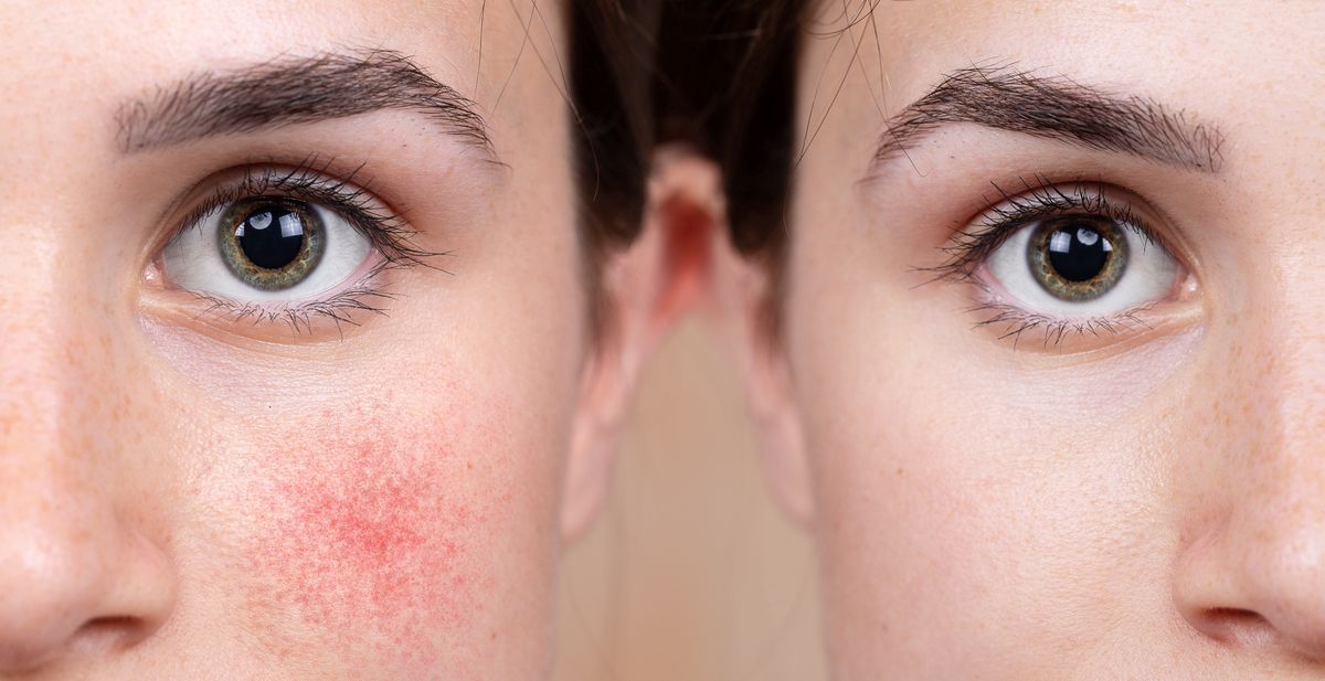 Rosacea – podstępna choroba, która męczy Polki