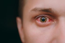 Pęknięte naczynko w oku – popularne przyczyny, zwiastun choroby, u ciężarnych